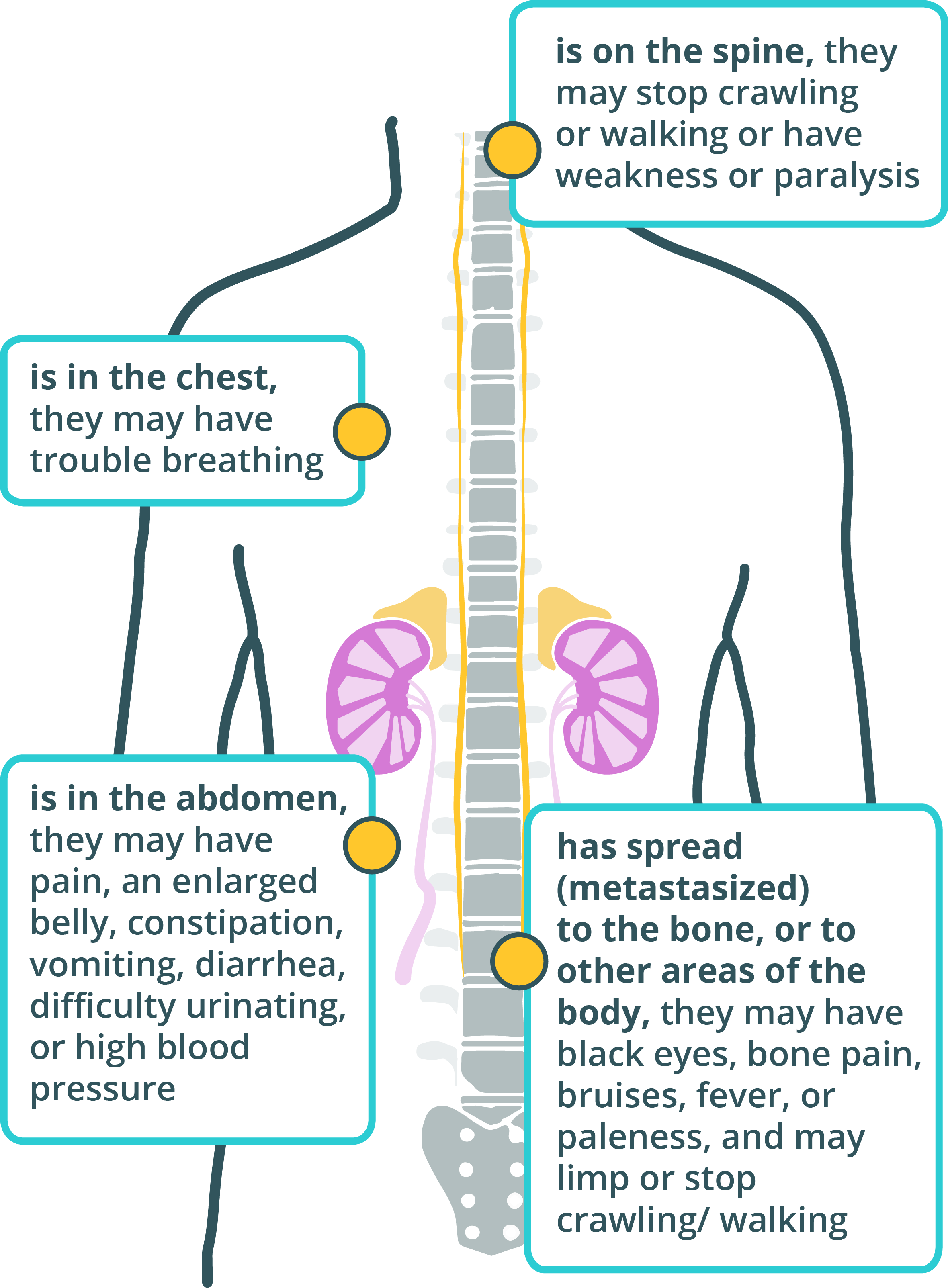 is on the spine, they may stop crawling or walking or have weakness or paralysis.
If a child has a tumor that is in the chest, they may have trouble
breathing. If a child has a tumor that is in the abdomen, they may have
pain, an enlarged belly, constipation, vomiting, diarrhea, difficulty
urinating, or high blood pressure. If a child has a tumor that has
spread (metastasized) to the bone, or to other areas of the body, they
may have black eyes, bone pain, bruises, fever, or paleness, and may
limp or stop crawling or walking.