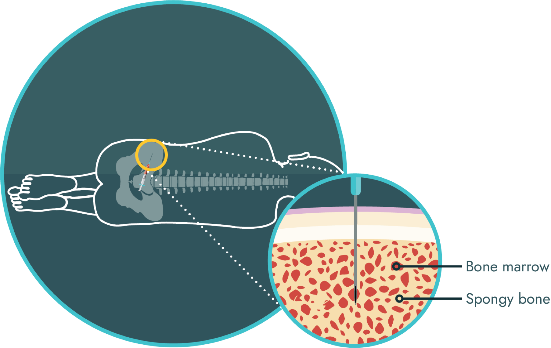 Biopsies are used to confirm a neuroblastoma diagnosis, the type of tumor, and if the cancer has metastasized to the bone marrow.