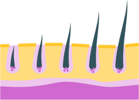After neuroblastoma treatment, hair regrowth is most common within 3 to 6 months