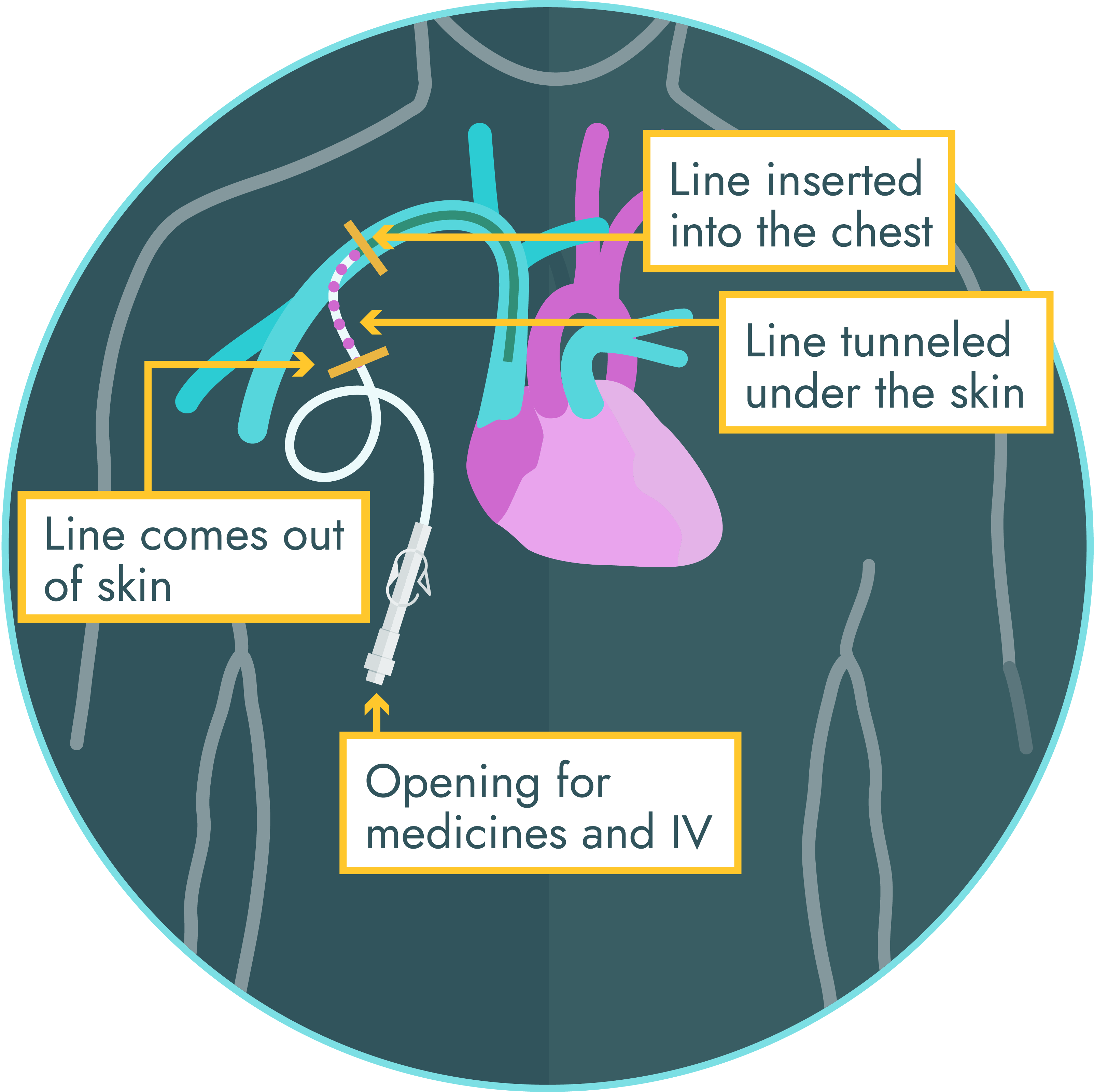 Illustration of the placement for a Broviac/Hickman central line