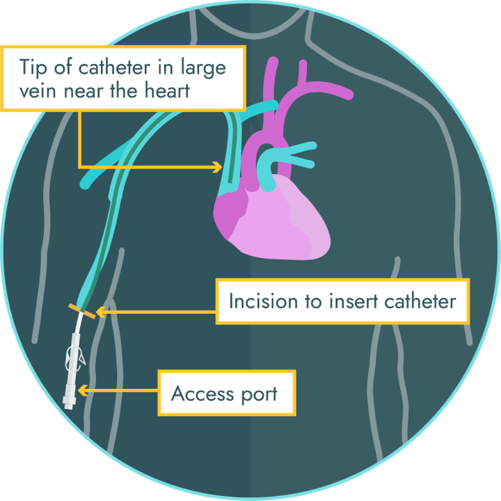 Illustration of the central line placement for a peripherally inserted central catheter.